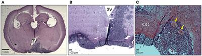 Circadian Alterations in a Murine Model of Hypothalamic Glioma